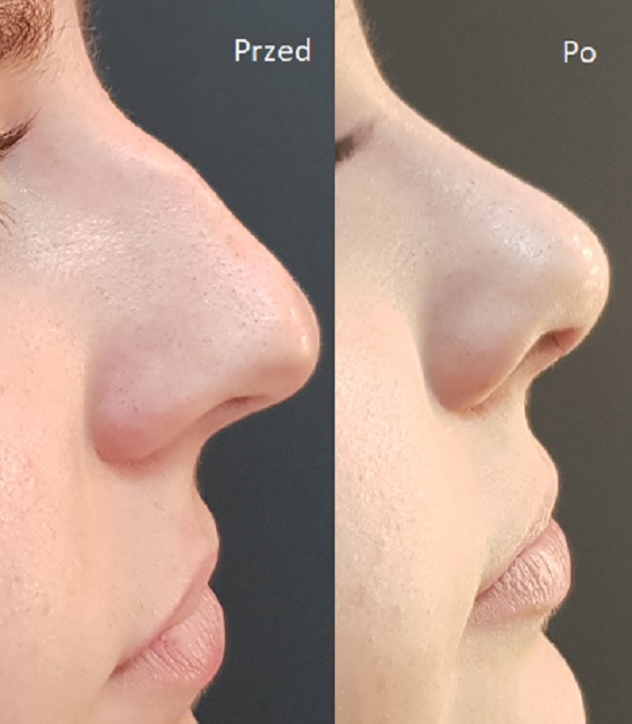 operacja plastyczna nosa