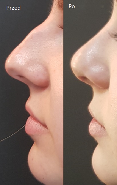 operacja plastyczna nosa